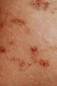Detailed view of skin with red spots and discoloration, common in dermatology studies.